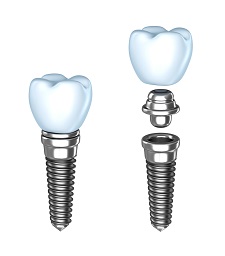 Fairfield, Bridgeport dental implants